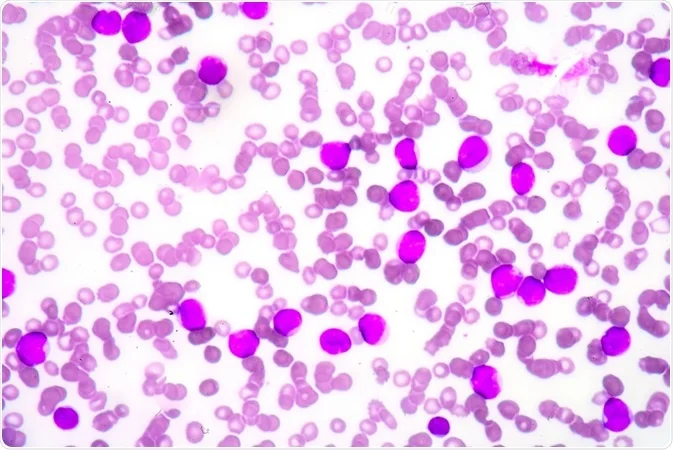 Aplastic Anemia