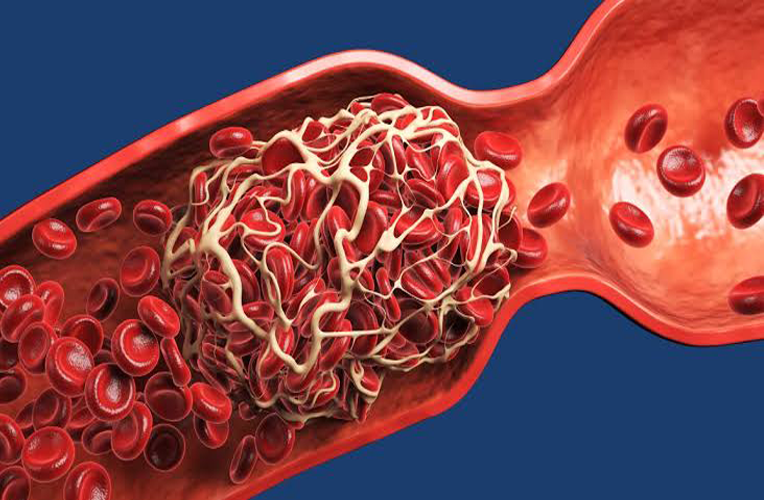 Blood Clot Prevention