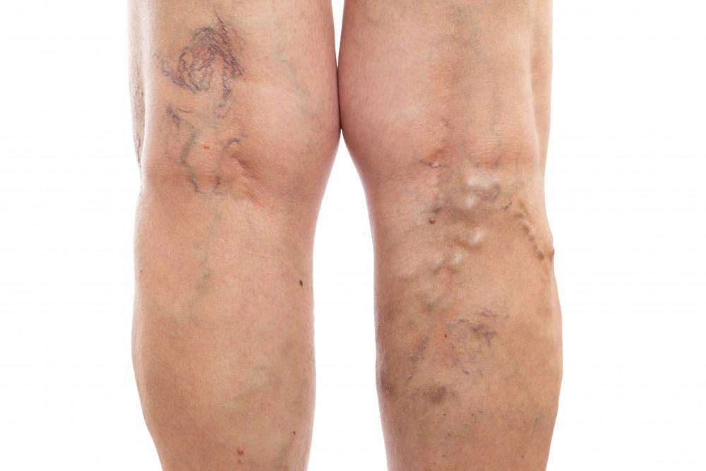 Deep Vein Thrombosis I Jeevan Amrut Hospital, Chh. Sambhajinagar