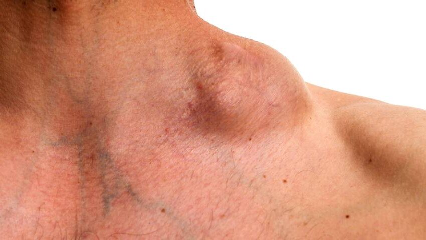 Lymphoma Treatment