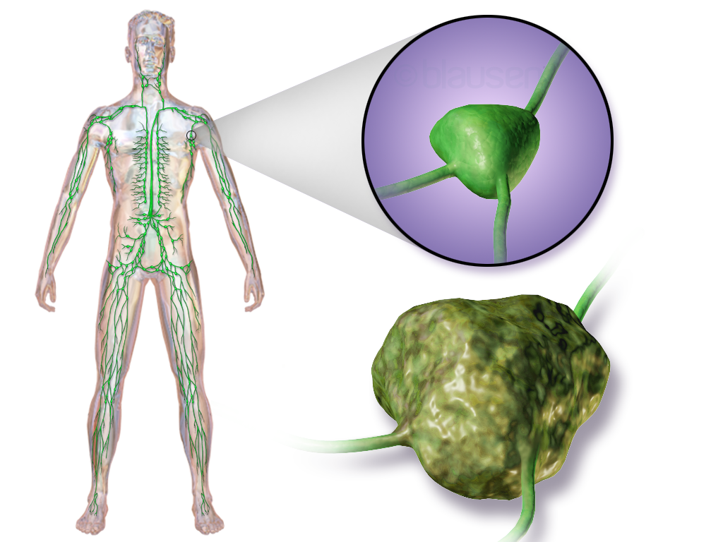Lymphoma Treatment in Chhatrapati Sambhajinagar
