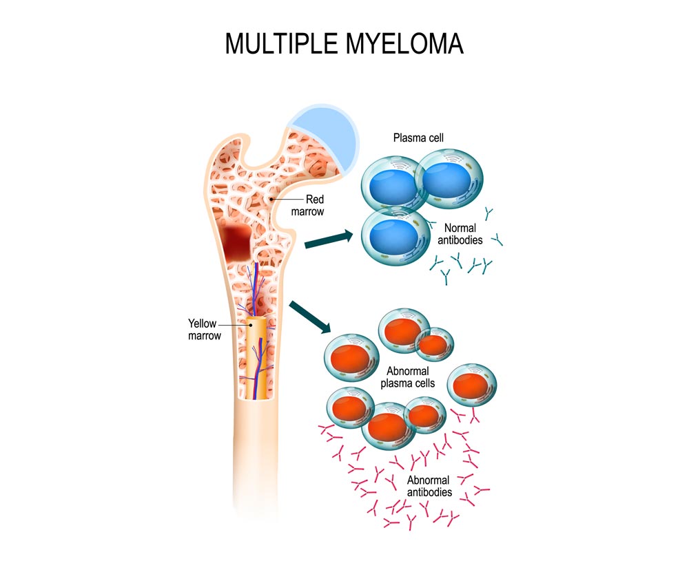 Blood Cancer Specialist in Chhatrapati Sambhajinagar
