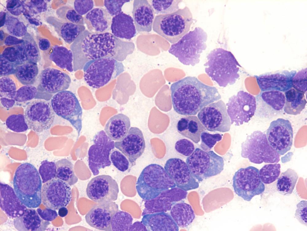 Blood Disorder Treatment