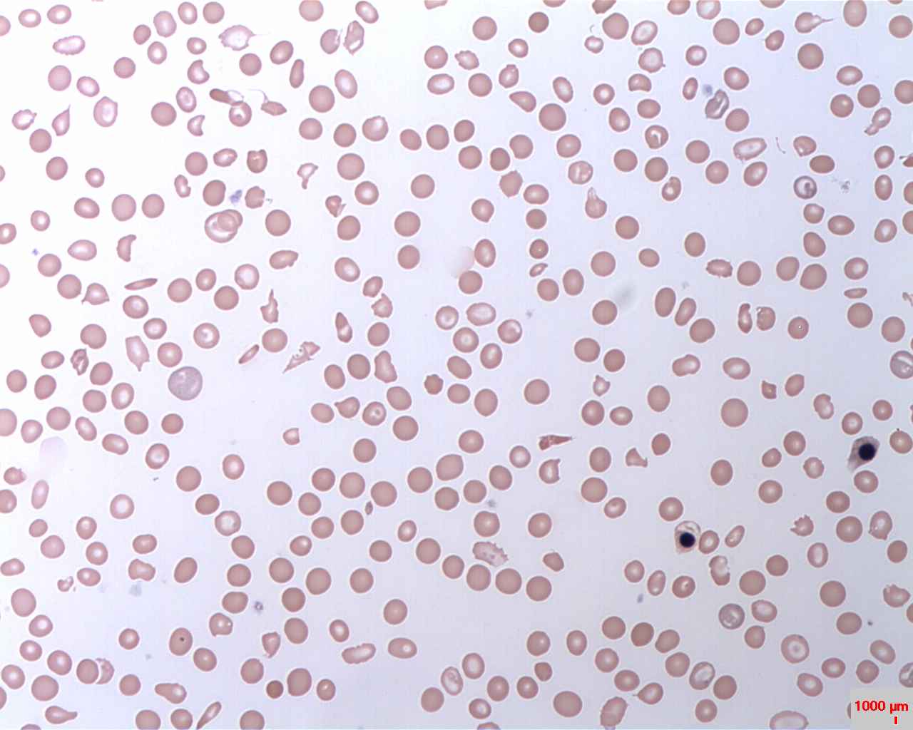Paroxysmal Nocturnal Hemoglobinuria PNH