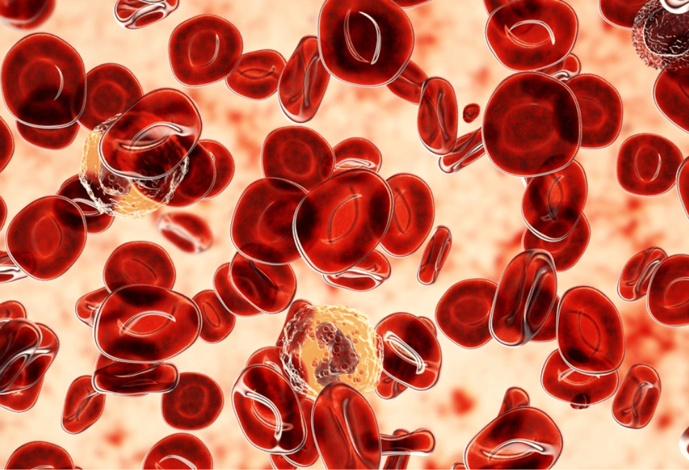 Polycythemia Vera