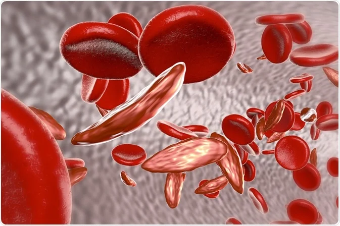 Sickle Cell Disease
