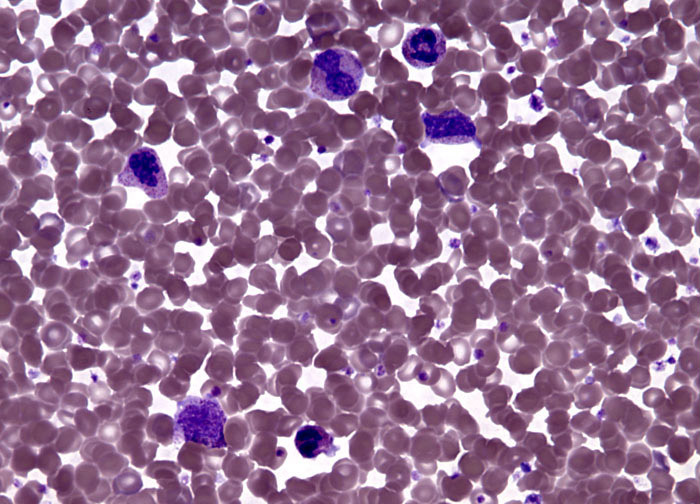 polycythemia 1